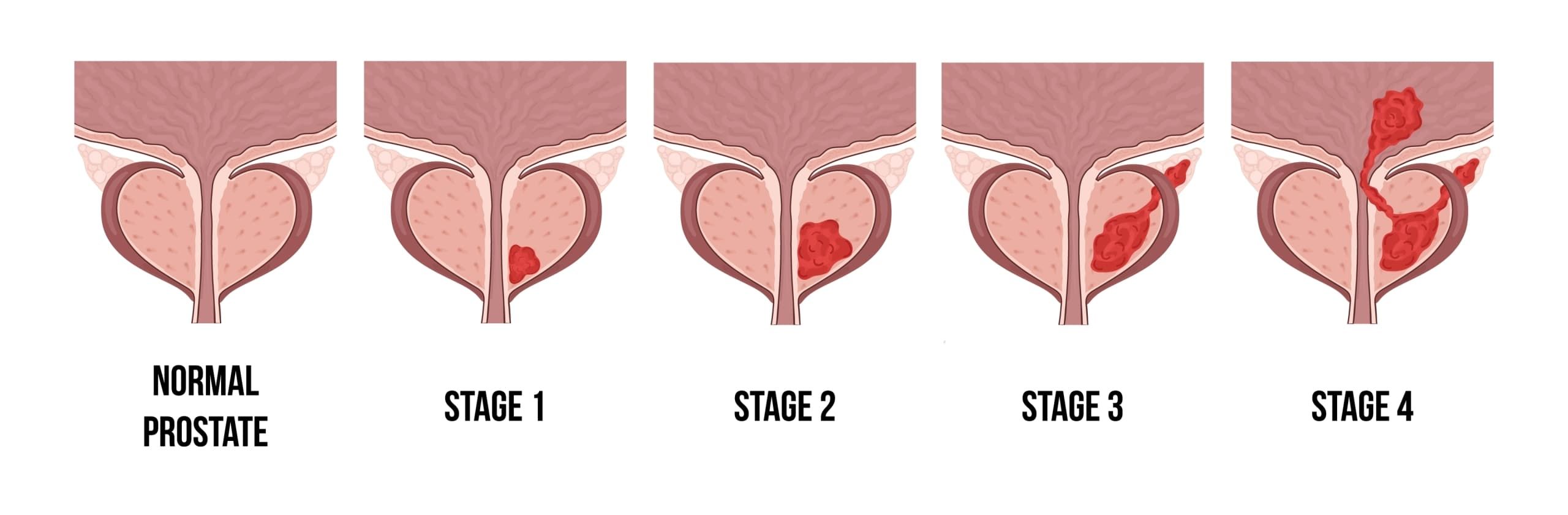 stages-of-prostate-cancer-scaled-1