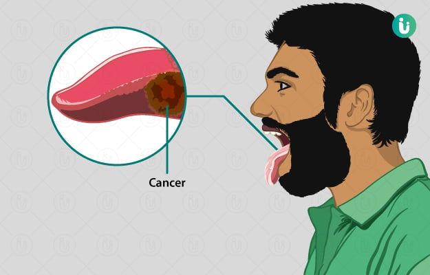 سرطان دهان و زبان