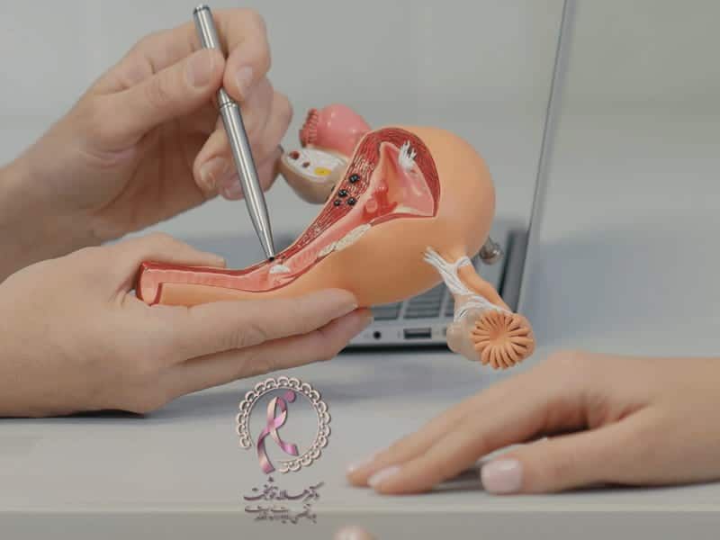 بهترین-دکتر-سرطان-رحم-در-تهران