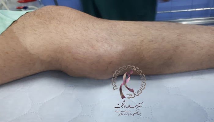 سرطان سارکوم سارکوما