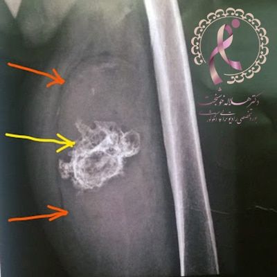 رویت سرطان سارکوما در عکس رادیولوژی