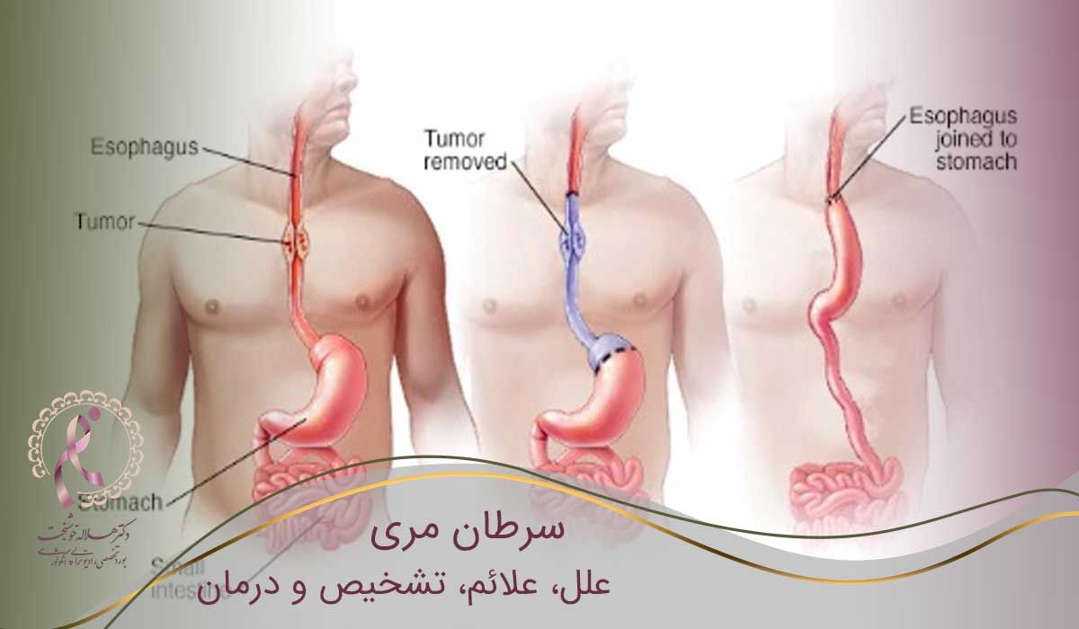 بهترین متخصص سرطان مری 